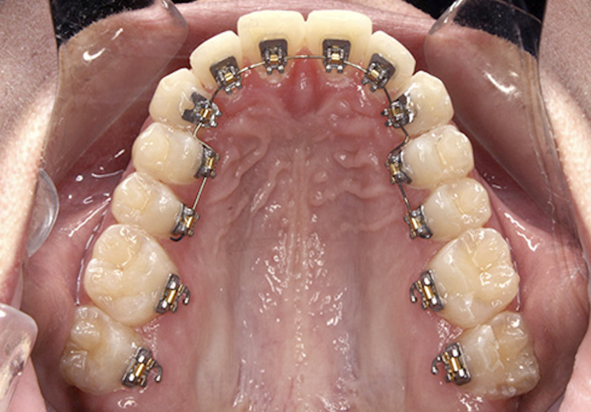 All about lingual braces Meaning, Cost, Effectiveness